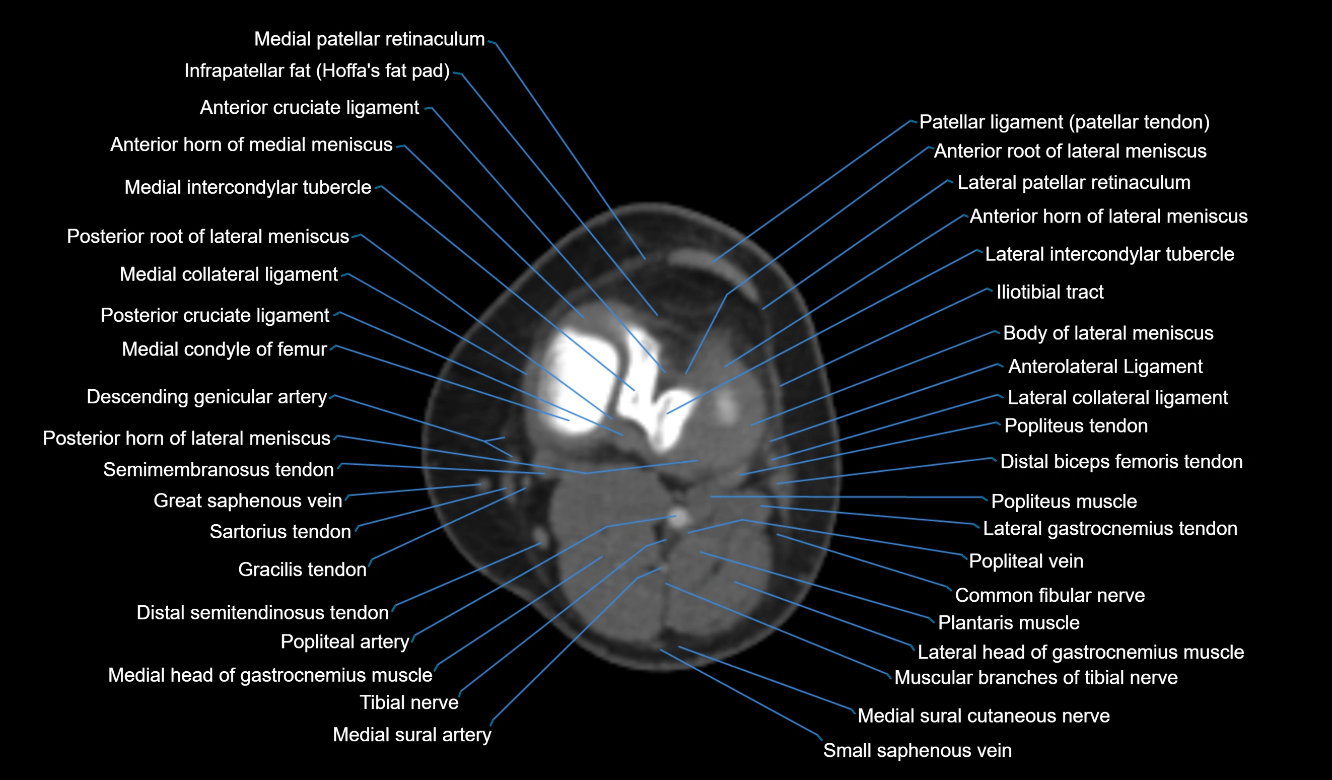 CT knee axial cross sectional anatomy labelled image-00036.webp